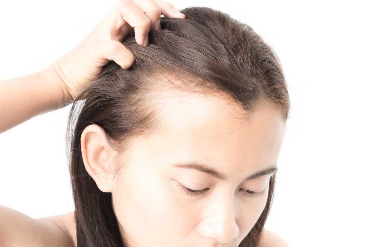 Three Causes of Hair Loss in Women | Hair for Life Center