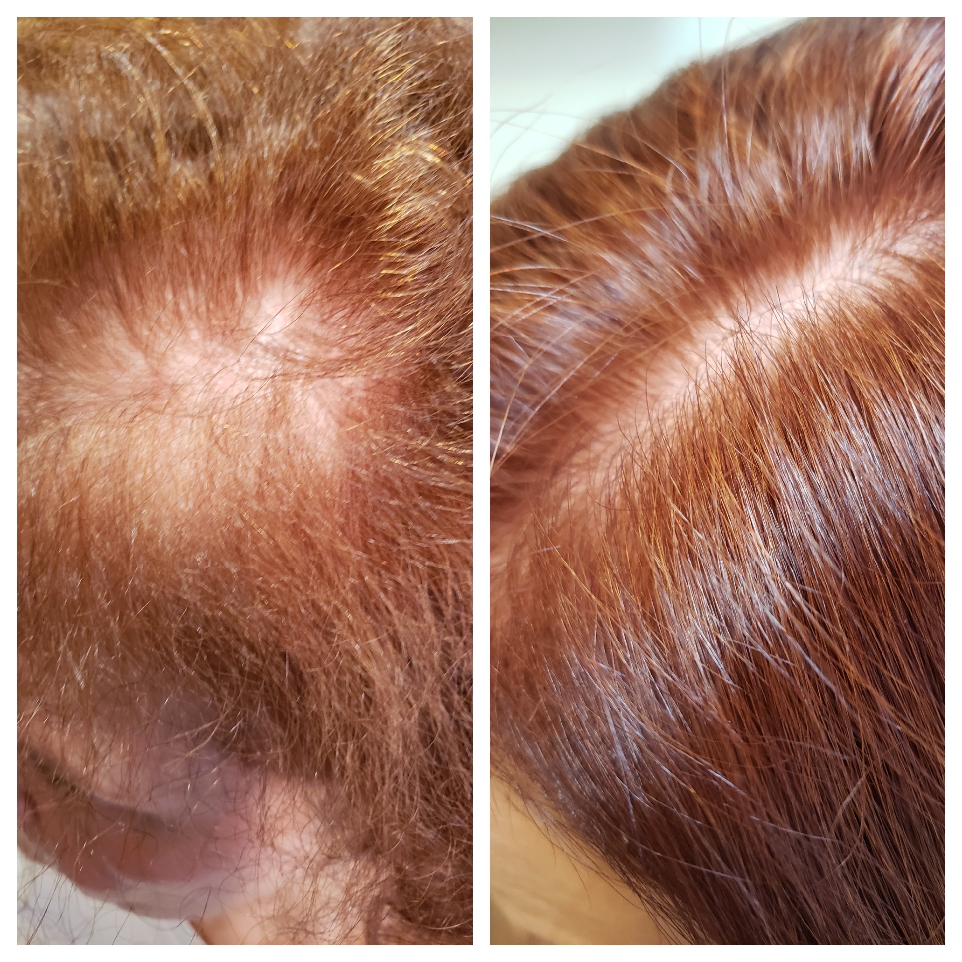 Before & Afters | Hair Replacement | Hair for Life Center